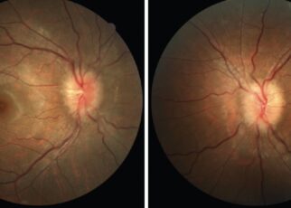 What are the main symptoms of papilledema?
